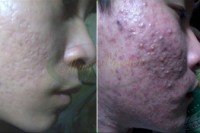 Trị mụn trứng cá - mụn bọc - mụn mũ - sẹo rỗ nặng - mụn cám - đầu đen - MSKH: TN7166